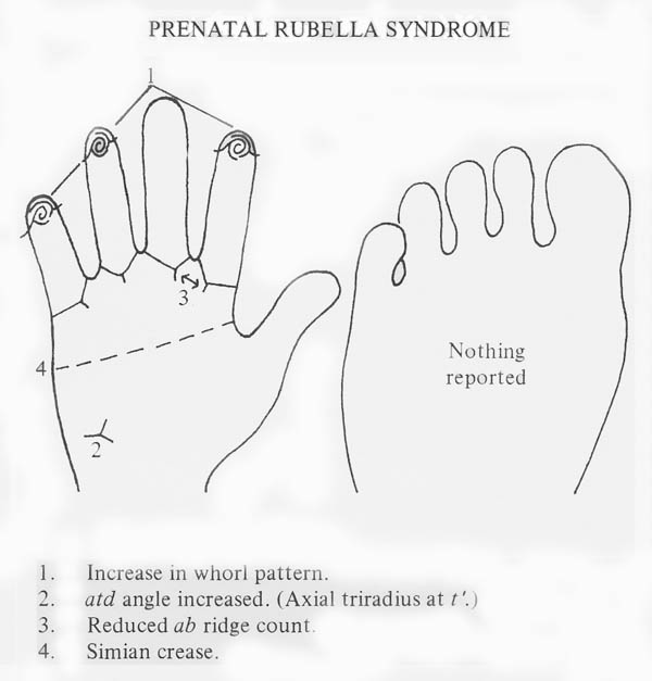 Hand chart for congenital rubella syndrome - Handbook of Clinical Dermatoglyphs (1971).