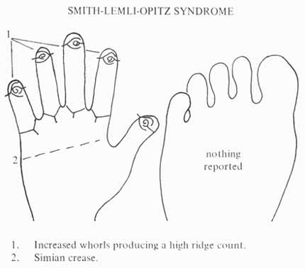 Phantom picture for the hand in Smith-Lemli-Opitz syndrome: dermatoglyphics & major palmar creases.