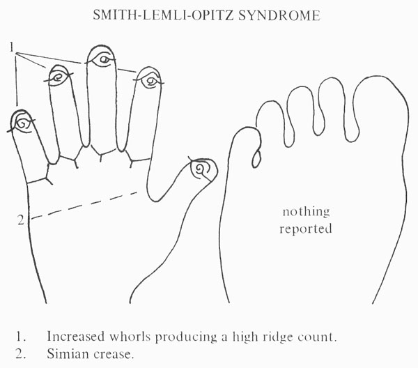 Hand chart for Smith-Lemli-Opitz syndrome - Handbook of Clinical Dermatoglyphs (1971).