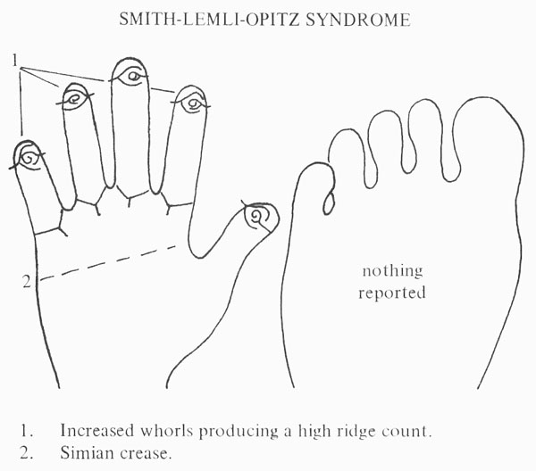 Typical hand characteristics in Smith-Lemli-Opitz syndrome.