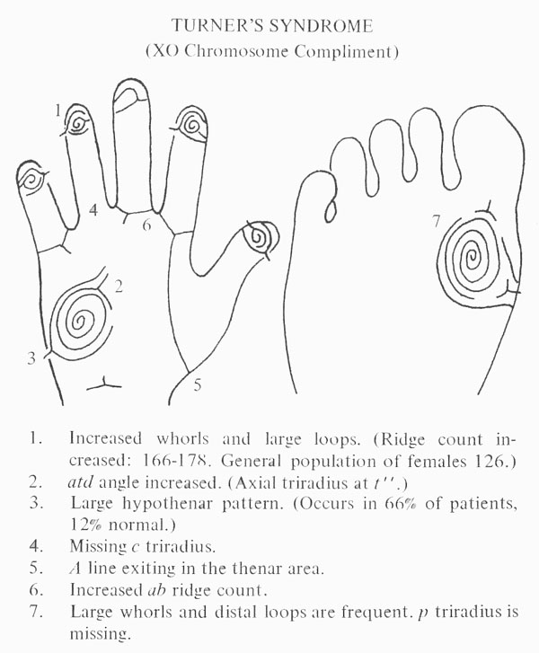 Hand chart for Turner syndrome - Handbook of Clinical Dermatoglyphs (1971).
