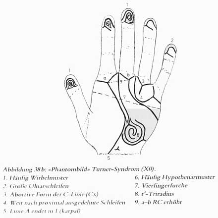 Phantom picture for the hand in Turner syndrome (XO): dermatoglyphics + major palmar lines.