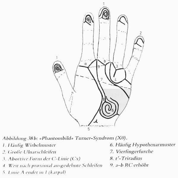 Hand chart for Turner syndrome.