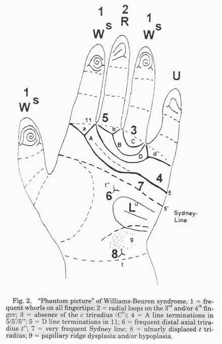 Phantom picture for the hand in Williams syndrome: dermatoglyphics + major palmar lines.