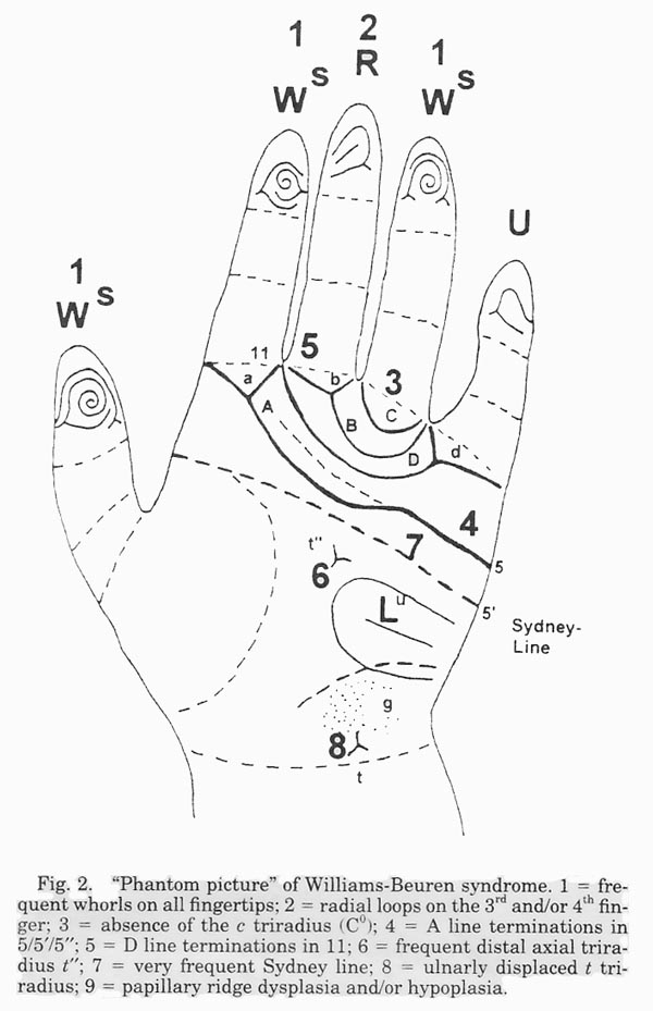 Hand chart for Williams syndrome (R. Rodewald, 1994)