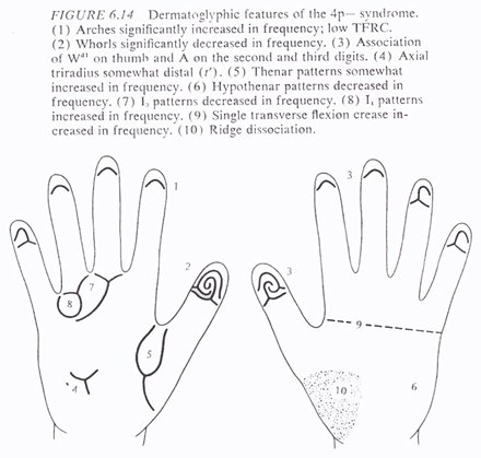 Phantom picture for the hand in Wolf-Hirschhorn syndrome (4p deletion syndrome): dermatoglyphics + major palmar lines.