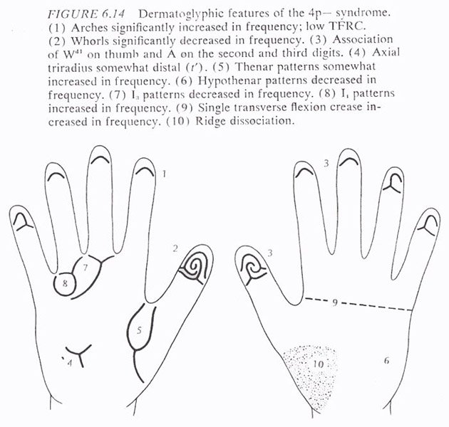 Hand chart for Wolf-Hirschhorn syndrome (B. Schaumann & M. Alter, 1976)