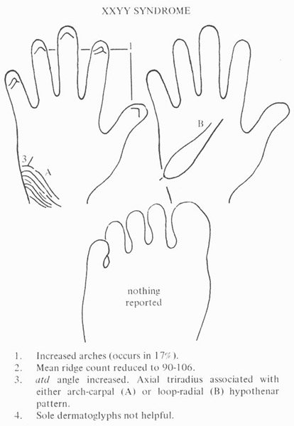 Hand chart for XXYY syndrome - Handbook of Clinical Dermatoglyphs (1971).