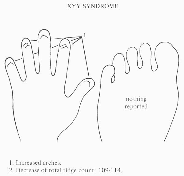 Hand chart for XYY syndrome - Handbook of Clinical Dermatoglyphs (1971).