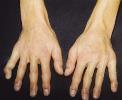 Case report: hands in patient with hypercalcemia (combined with acrodysostosis).