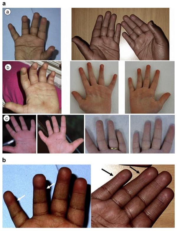 Missing interphalangeal distal creases in Kabuki syndrome.