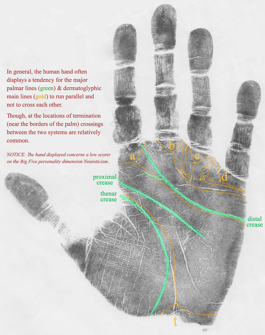 Hand of Neuroticism low scorer displaying 'parallel systems' involving the major transverse creases & the dermatoglyphic main lines.