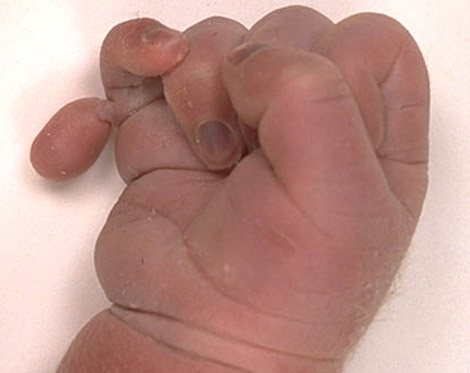 Polydactyly with overlapping fingers (clenched hand) in Patau syndrome.