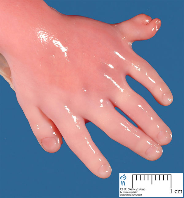 Baby hand involving Smith-Lemli-Opitz syndrome: post-axial polydactyly.