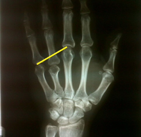 Positive metacarpal sign: shortening of the 4th metacarpal is the most characteristic skeletal finding in Turner syndrome.