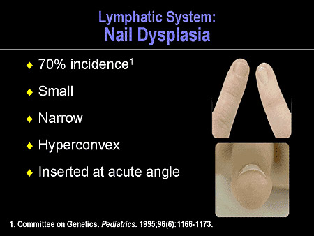 Turner syndrome nail features (70% incidence): small, narrow, hyperconvex, inserted at acute angle.