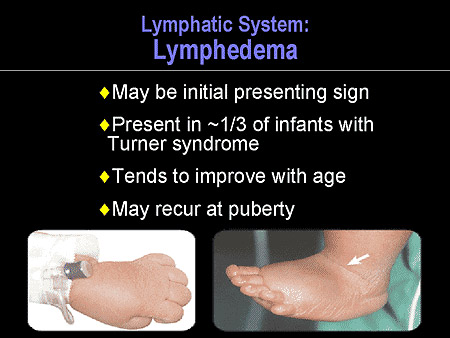 Positive metacarpal sign: shortening of the 4th metacarpal is the most characteristic skeletal finding in Turner syndrome.