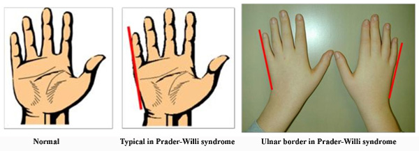 Ulnar border in Prader-Willi syndrome hands.