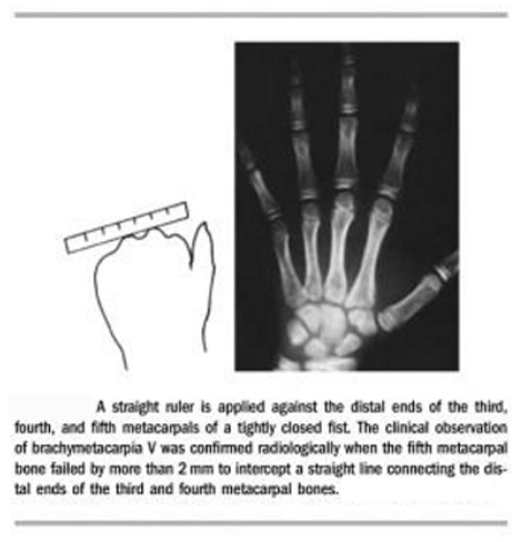 A short 5th metacarpal bone is common in about half of Williams syndrome patients.