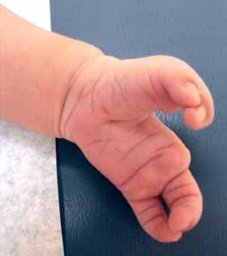 Ectrodactyly (split hand) in Wolf-Hirschhorn syndrome.