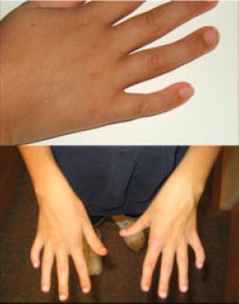 5th finger clinodactyly in XXYY syndrome.