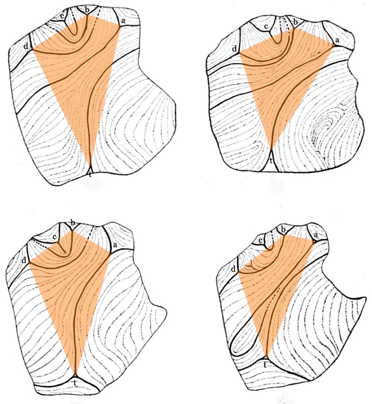 Palmar dermatoglyphics & the palmar triradial zone: 4 examples.