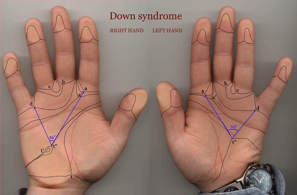 Down syndrome & the hand: case study 1.