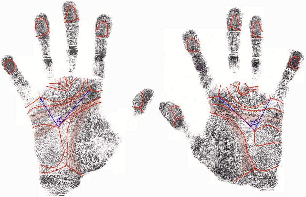 The hand in Down syndrome: case 2.