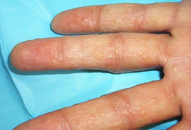 SLIDESHOW  The many faces of eczema in hands!.