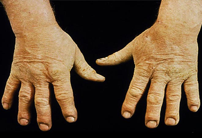 Eczema in hands - irritant Dermatitis On Hands. Eczema in hands - irritant