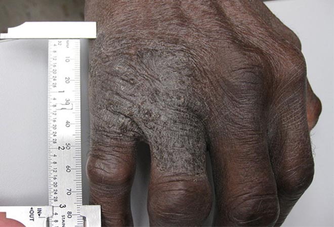 Eczema in hands - lichen simplex chronicus.