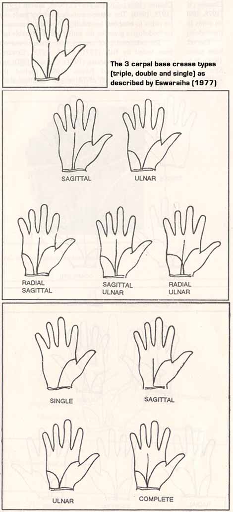 Eswaraiha (1977) described three carpal base crease types.