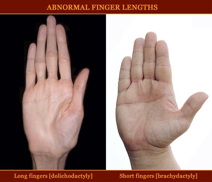 Abnormal finger lengths: long fingers vs. short fingers.