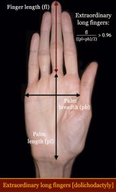 Extraordinary long finger length: dolichodactyly.