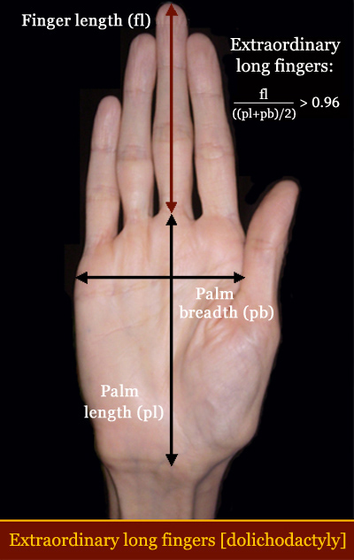 Abnormal long finger length [dolichodactyly] in Down syndrome.