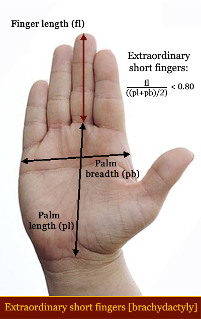 Abnormal short finger length [brachydactyly] in Down syndrome.