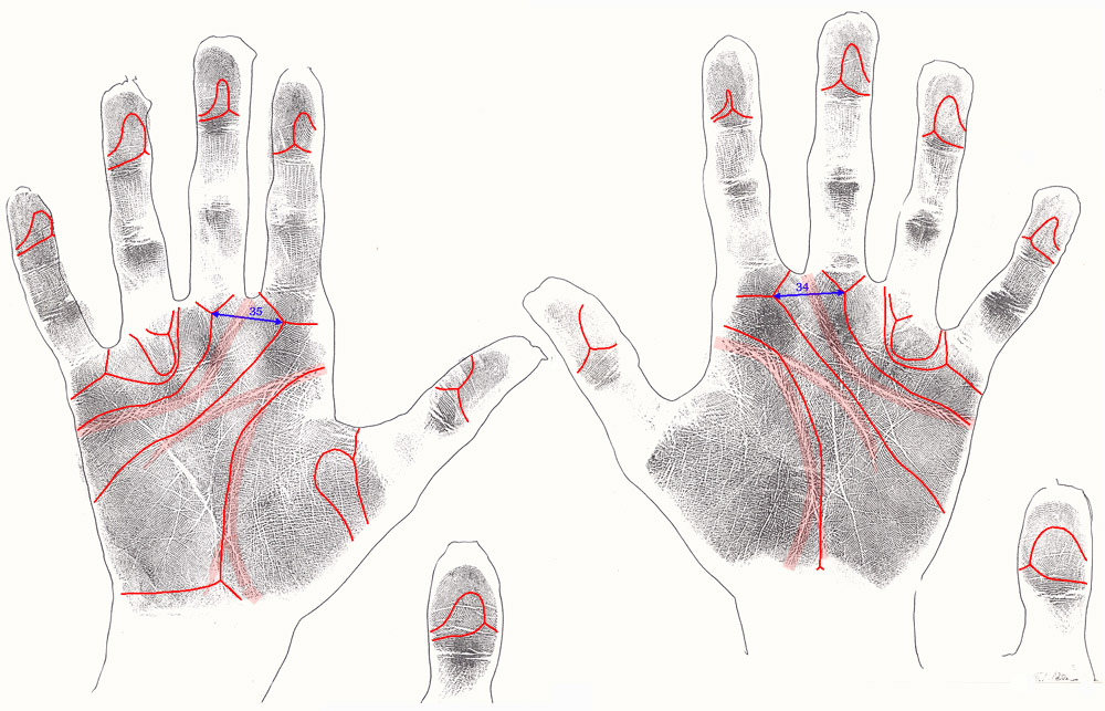 The hand in fragile-x syndrome: case 1.