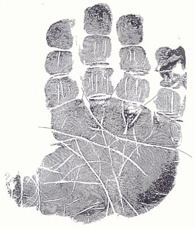 The hand in fragile-x syndrome: case 2.
