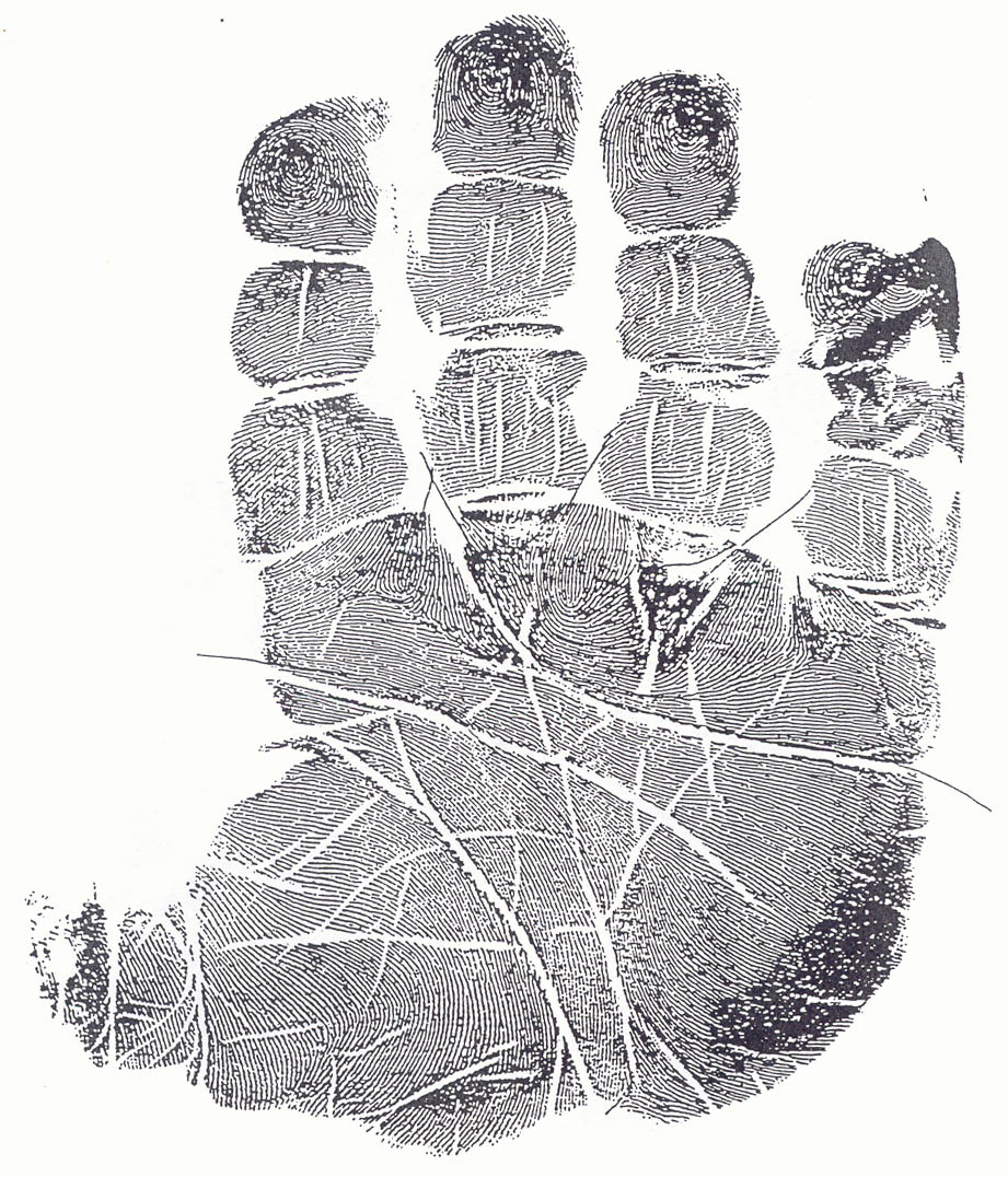 The hand in fragile X syndrome: case 2.