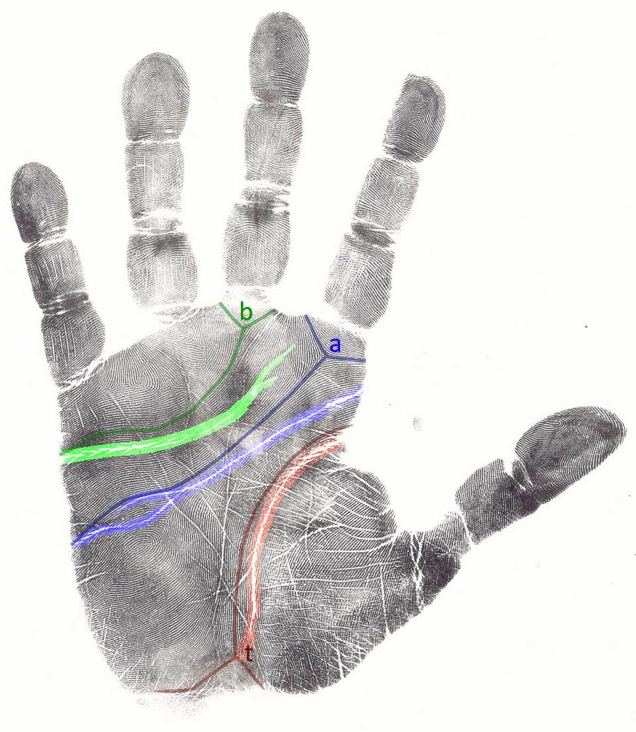 Primary lines & dermatoglyphics (dermatoglyphic main lines a, b & t)