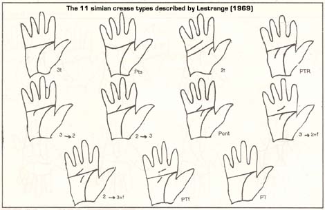 Lestrange (1969) described 11 simian crease types.