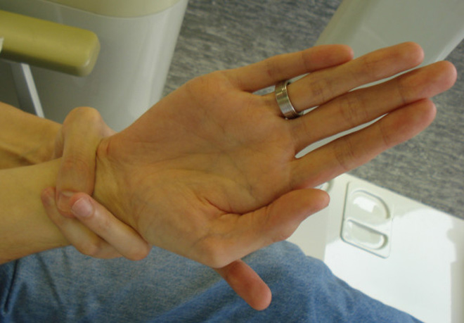 Extraordinary long fingers in Marfan syndrome: finger length index >> 1.00.