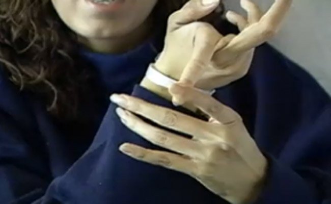 Marfan syndrome: flexibility sign in the fingers is typical.