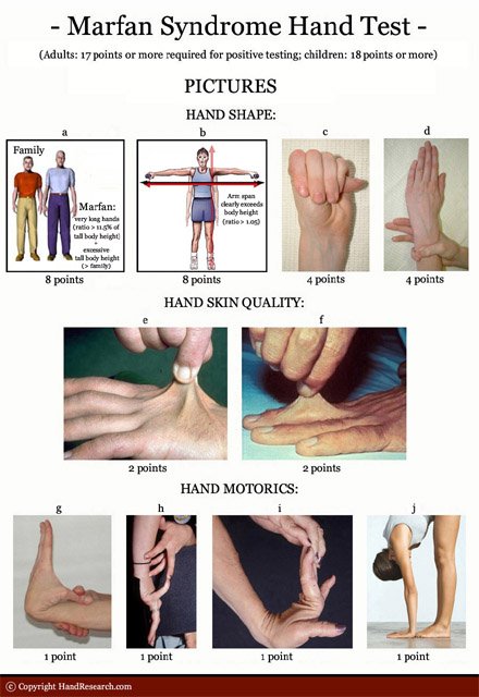 Impressions of the hand in Marfan syndrome: the Marfan syndrome hand test.