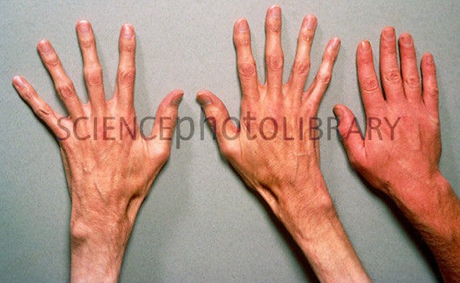 Marfan syndrome: long hands is a typical feature.