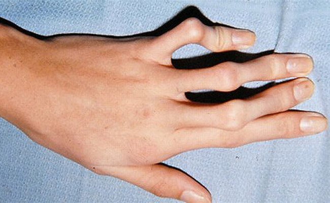 Marfan syndrome: spider-fingers is a very characteristic feature.