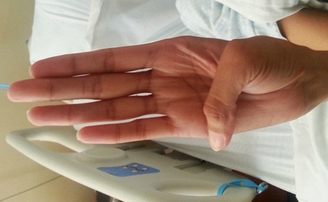 Marfan syndrome: the Steinberg sign for the thumb.