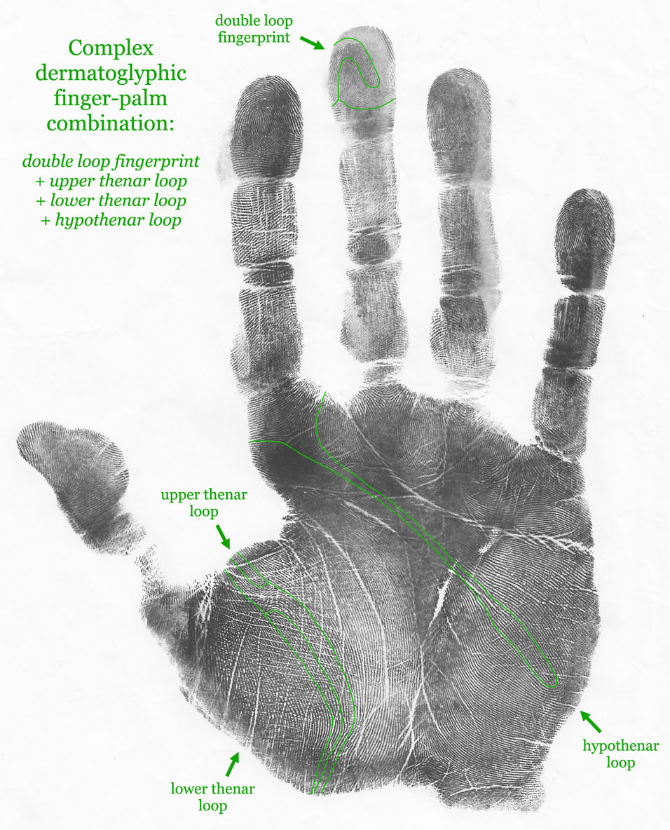 Complex dermatoglyphic finger-palm combination, with: double loop fingerprint, upper thenar loop, lower thenar loop & hypothenar loop.