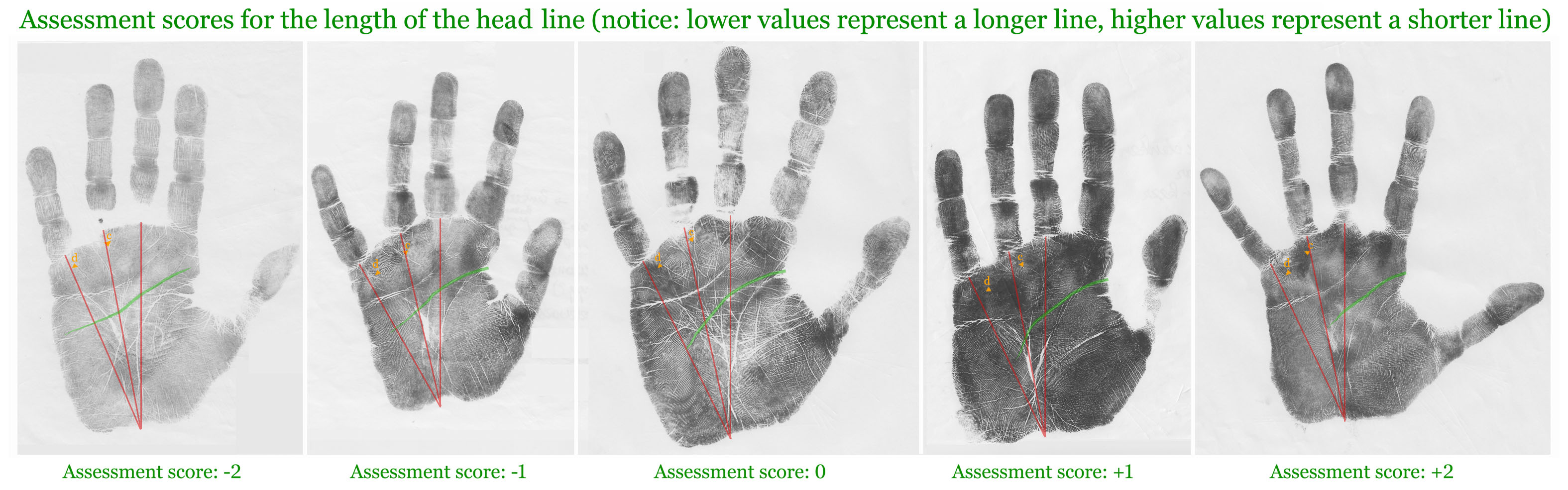 Assessment scores for the length of the head line [lower transverse crease].