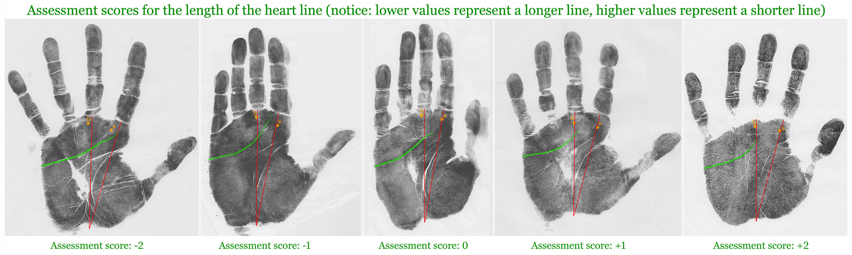 Assessment scores for the length of the heart line [upper transverse crease].